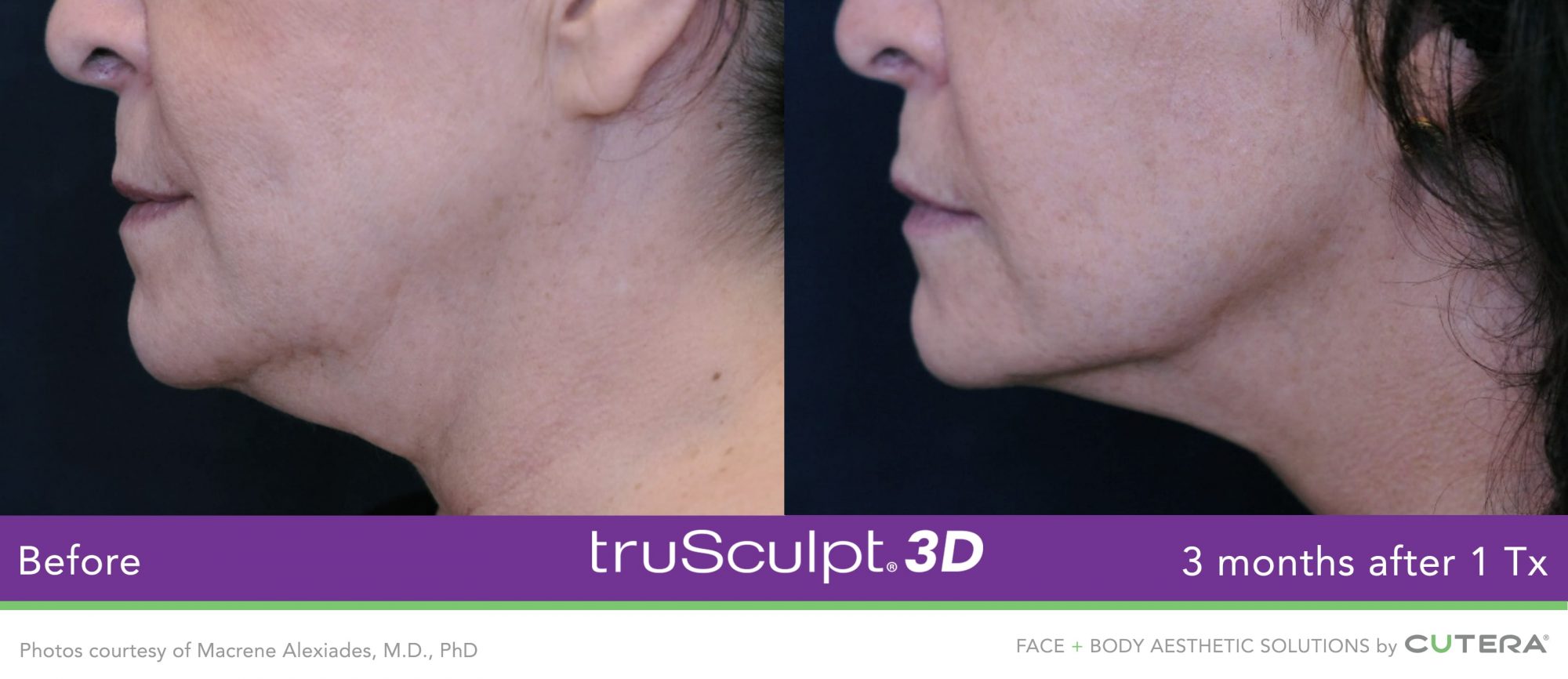 woman's chin before and after truSculpt 3D